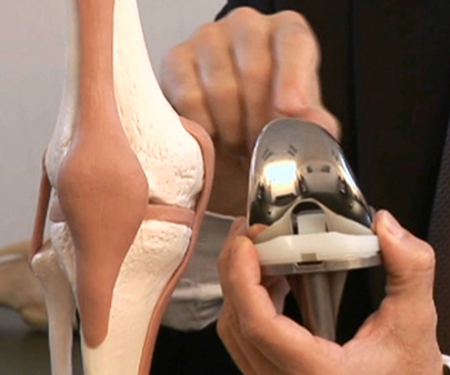 La prothèse totale de genou (PTG)